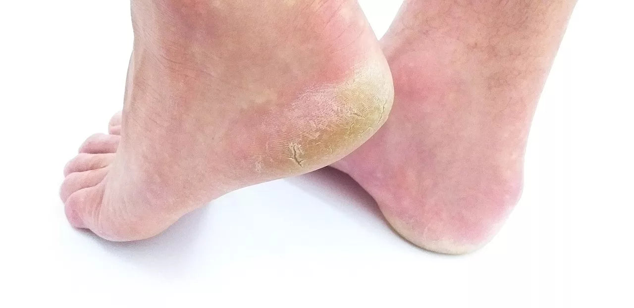 How to Fix Cracked Heels at Home