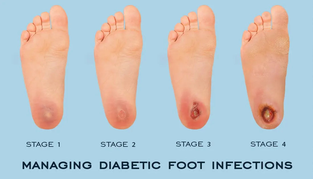 How does being a diabetic affect your feet?