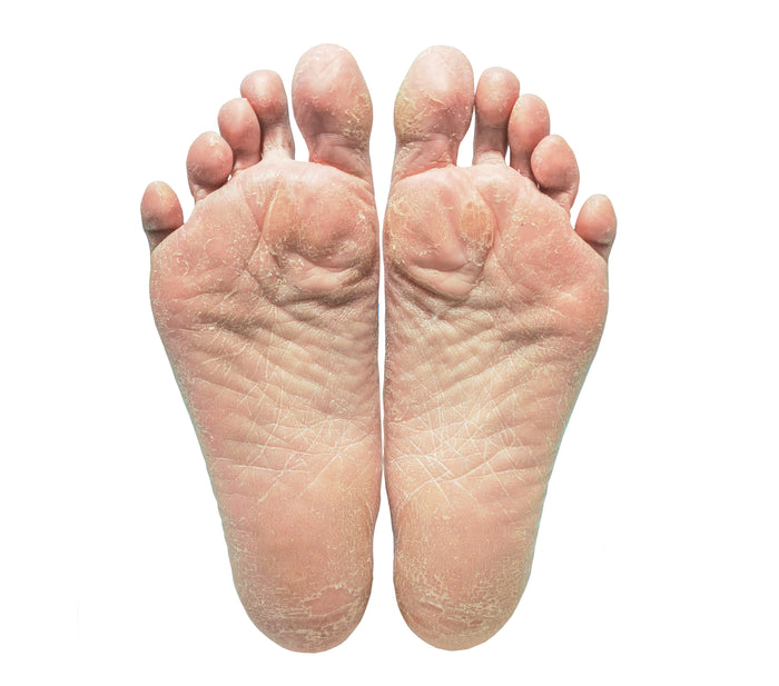 The Ultimate Guide to Addressing Foot Cracks and Problems: Introducing Foottex - Your Go-To Foot Moisturizer