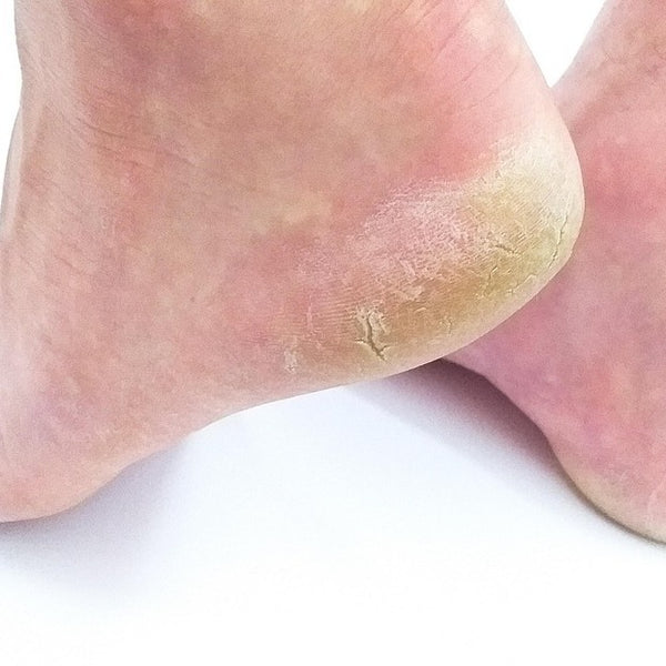 Calluses on heels