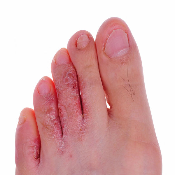 Flaky dead skin on toes