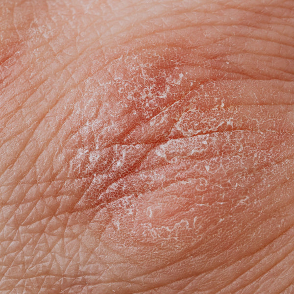 Dry, peeling skin