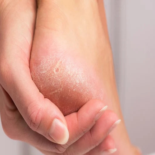Cracked heels
